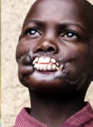 African boy attacked by chimps getting facial surgery in U.S.