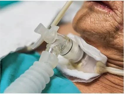 Artificial Airway Management