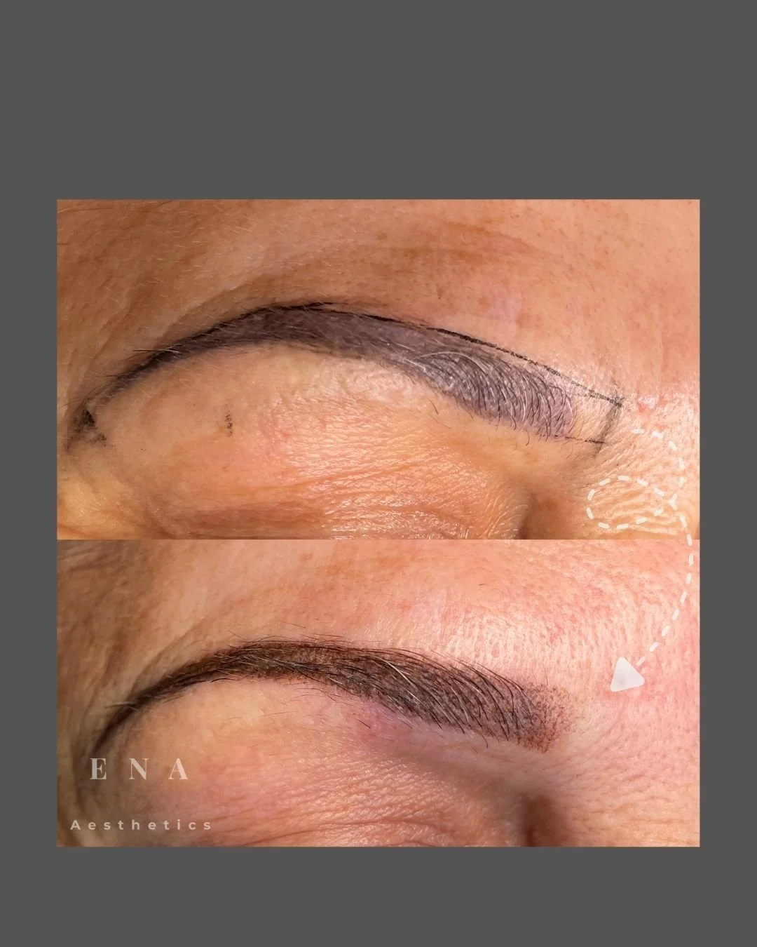 Before and after Combination Brows treatment combining colour correction, nano hairstrokes and soft powder shading to enhance facial harmony and create natural-looking, personalised results.