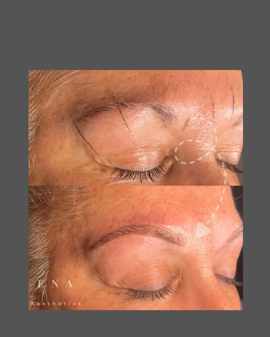 Before and after Combination Brows treatment tailored to recreate natural brow structure, enhance facial harmony and provide soft, balanced definition through nano hairstrokes and powder shading.