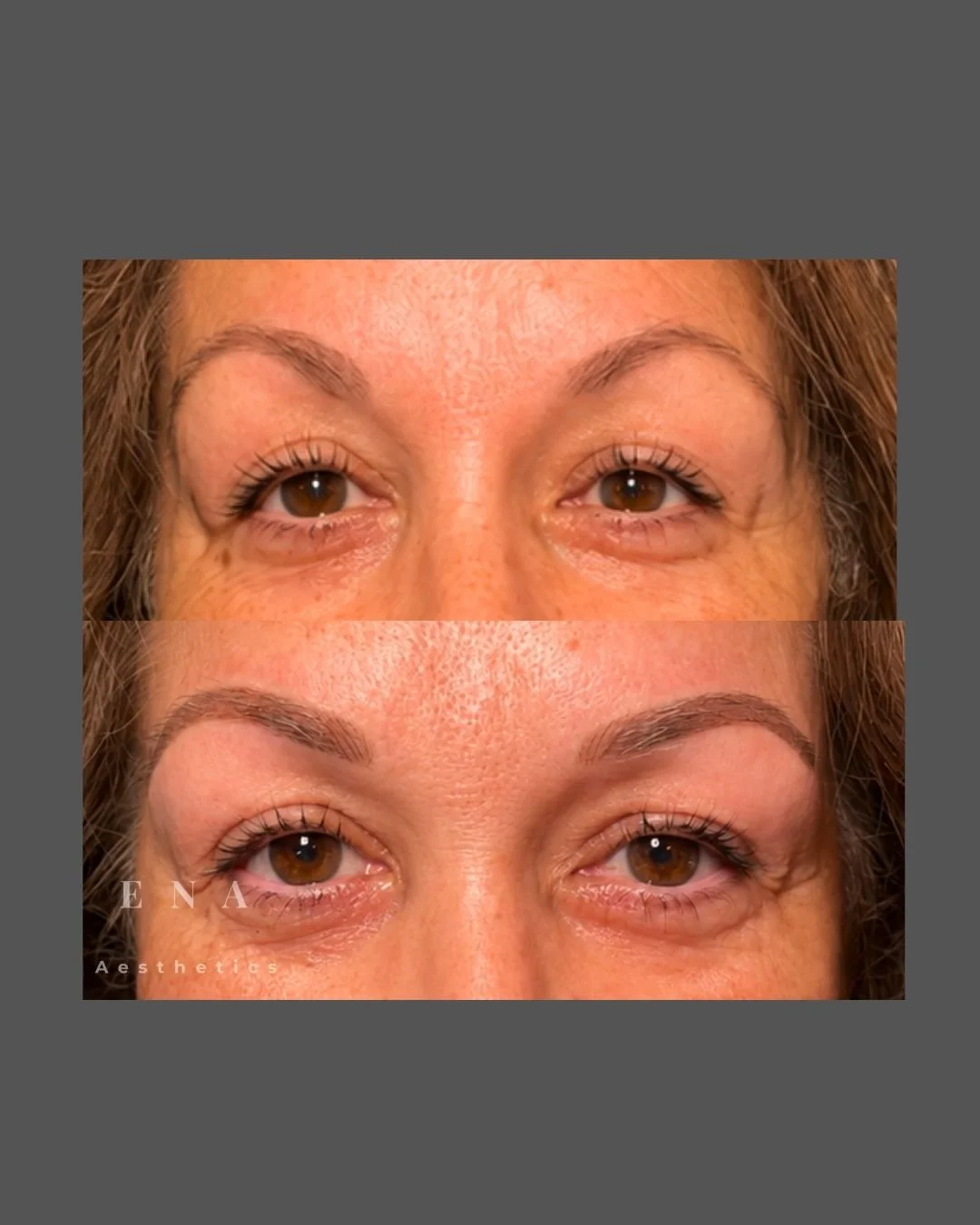 Before and after Combination Brows treatment focused on restoring balance and improving brow shape. A combination of nano hairstrokes and soft powder shading creates a naturally defined result designed to complement the client's features.