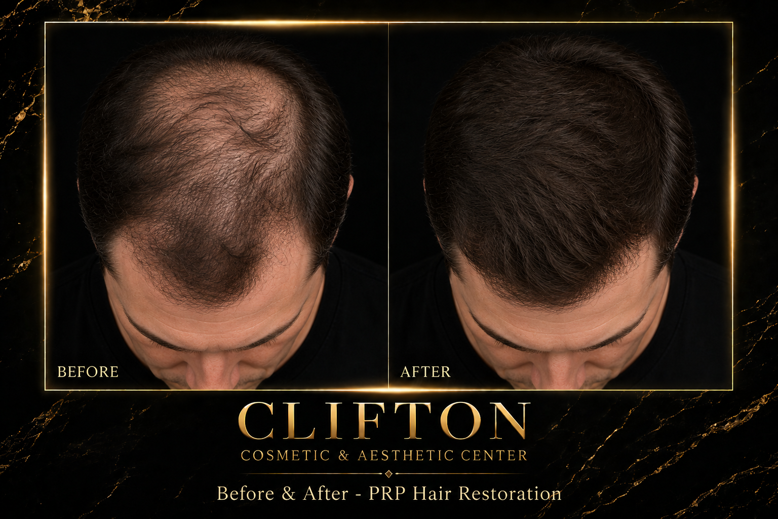 PRP  PRF HAIR RESTORATION.png