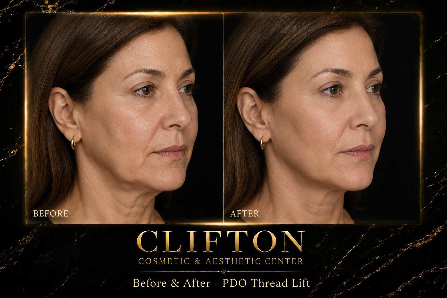 Photorealistic luxury medical Before and After for PDO Thread Lift..png
