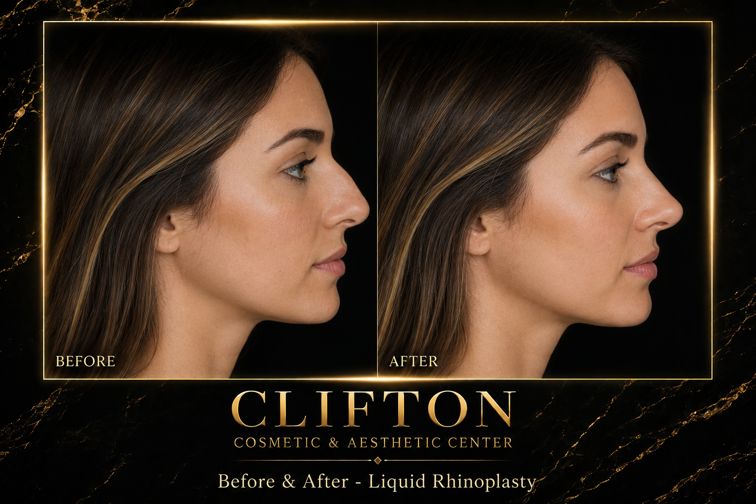 LIQUID RHINOPLASTY.png