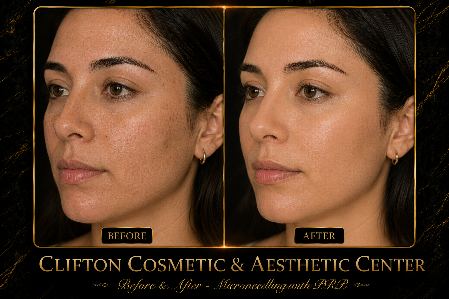 Microneedling with PRP Vampire Facial.png