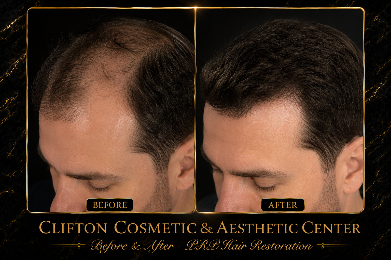 PRP PRF Hair Restoration.png