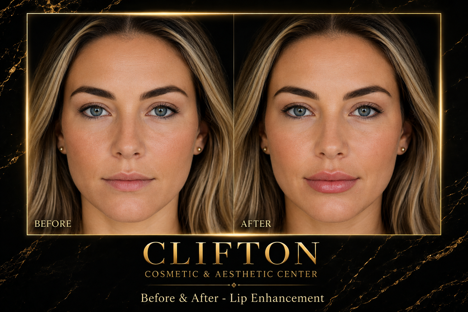 LIP ENHANCEMENT.png