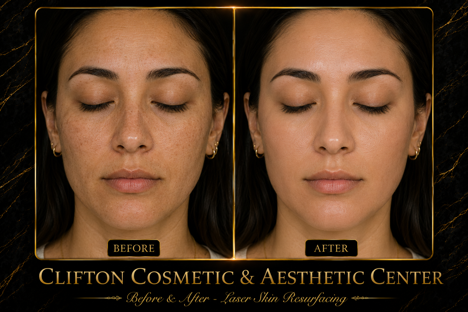 Chemical PeelLaser Resurfacing.png