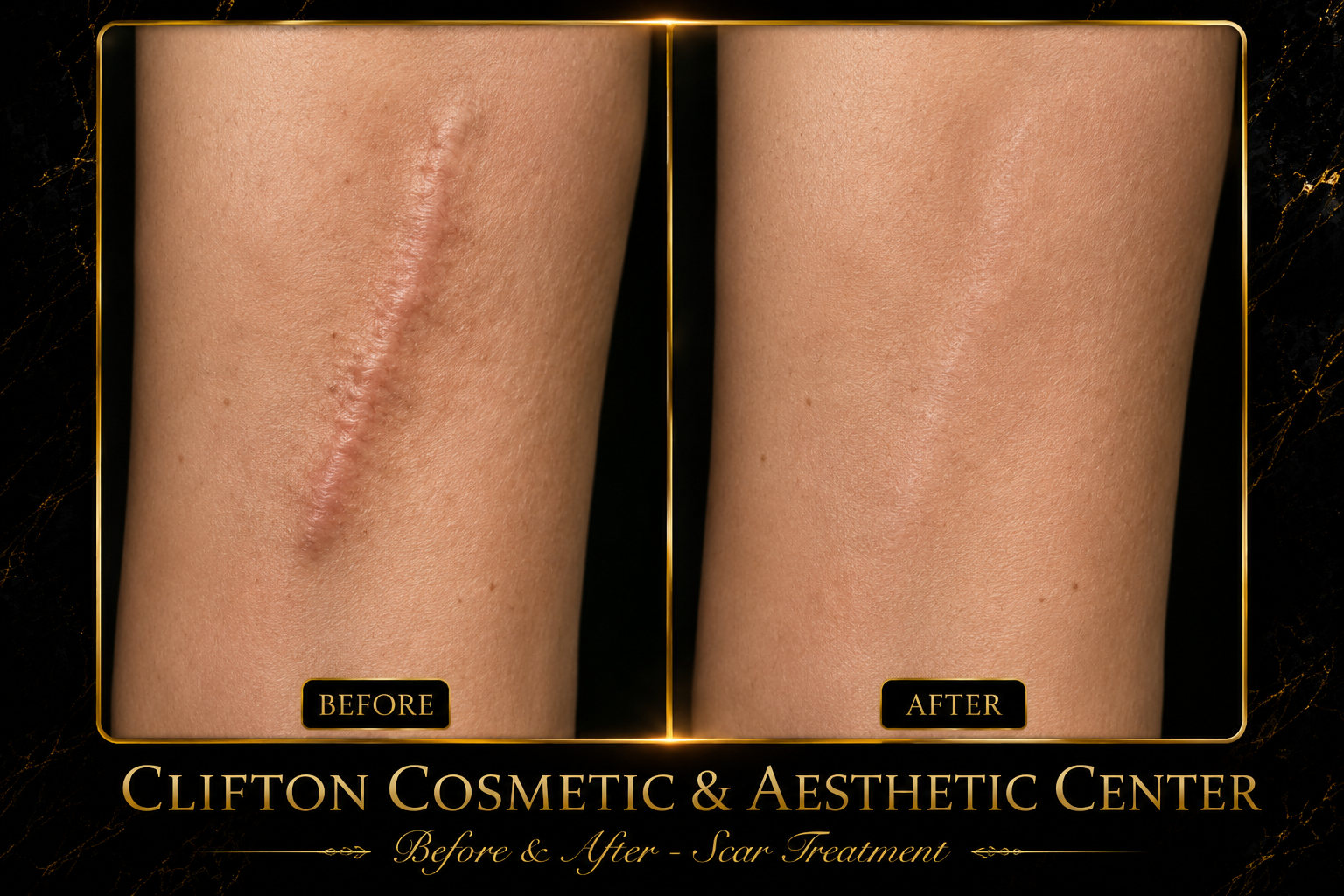 Scar Treatment.png