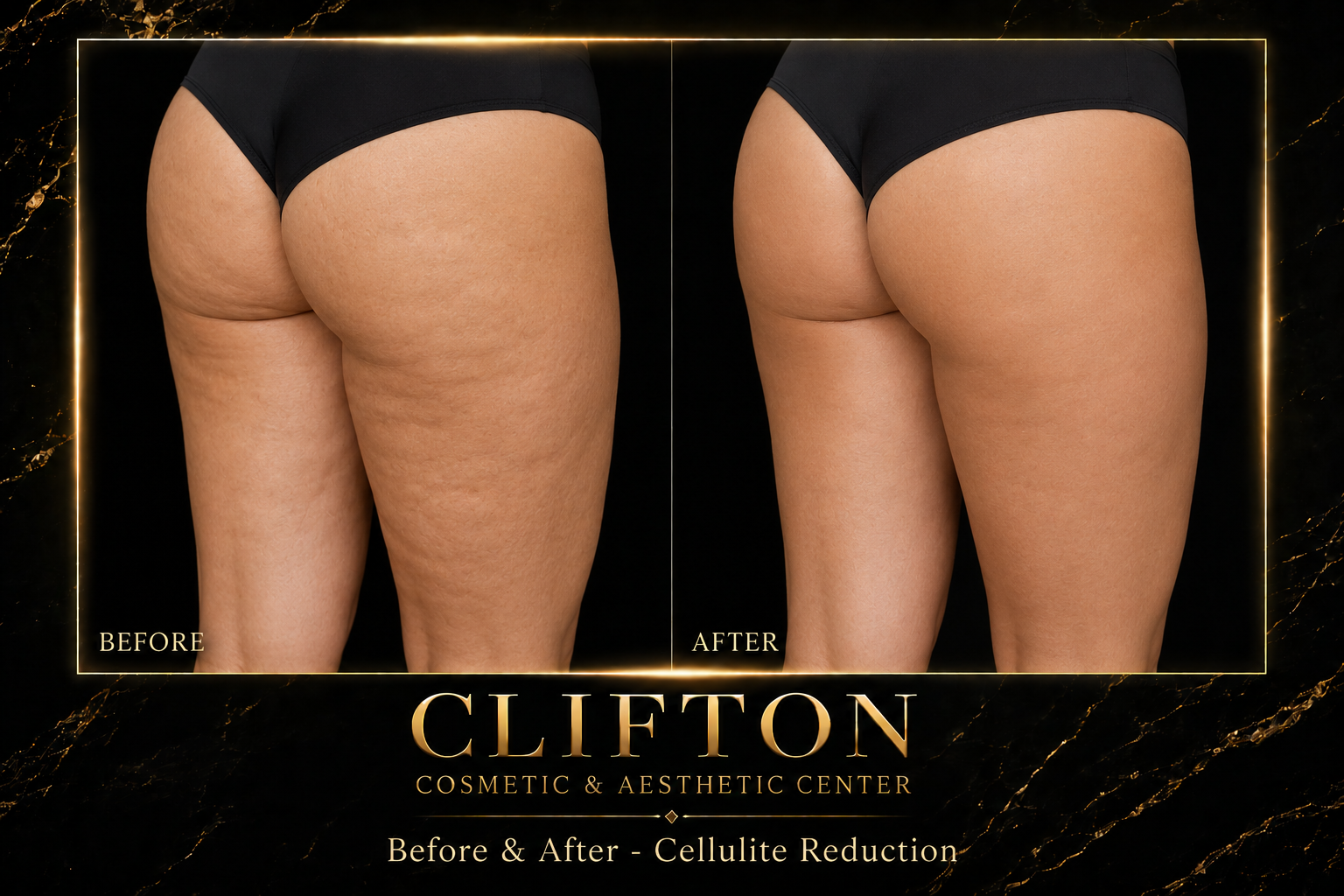 CELLULITE REDUCTION.png