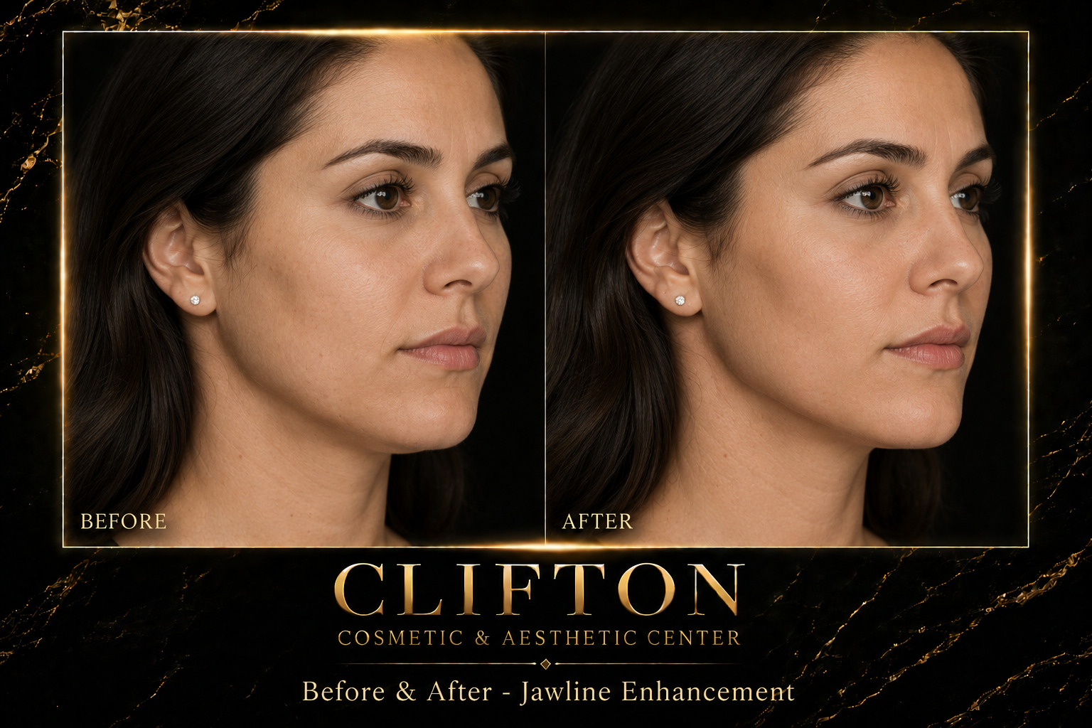 JAWLINE FILLERS.png