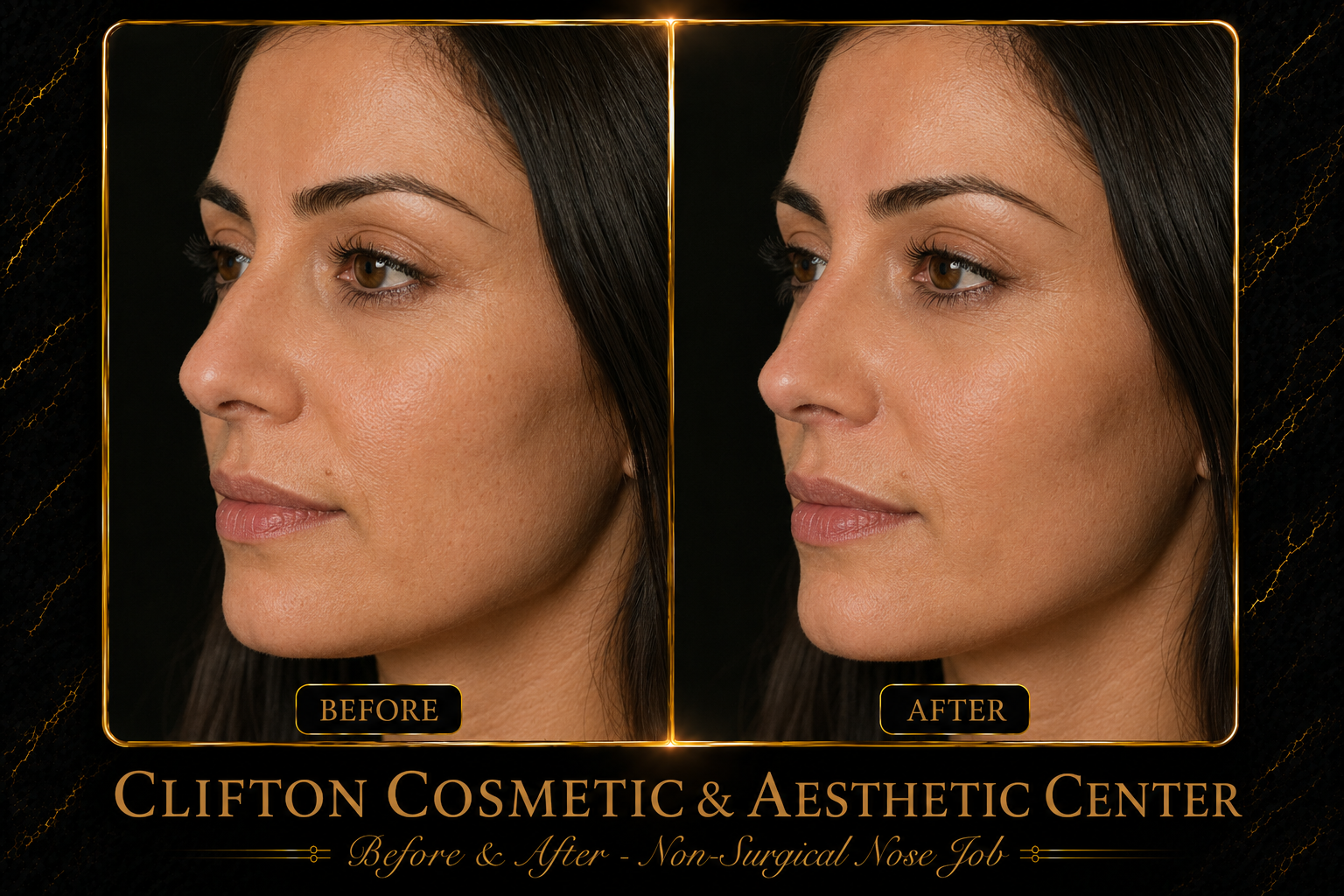 before and after for Non-Surgical Nose Job.png