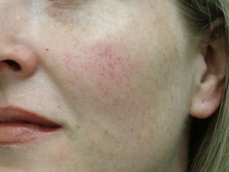 Close up of mild broken capillaries on the cheek near the nose