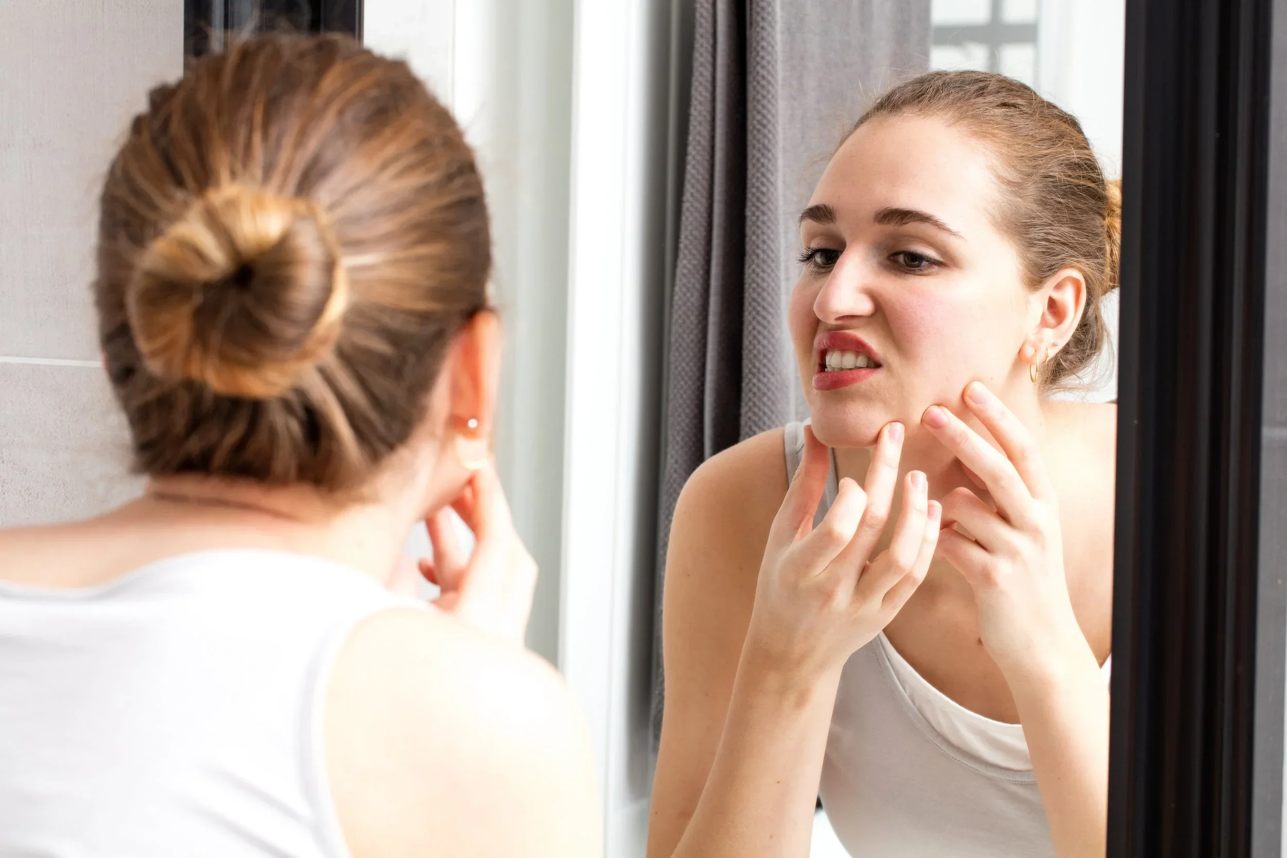 Acne around the Nose, Mouth and Chin?