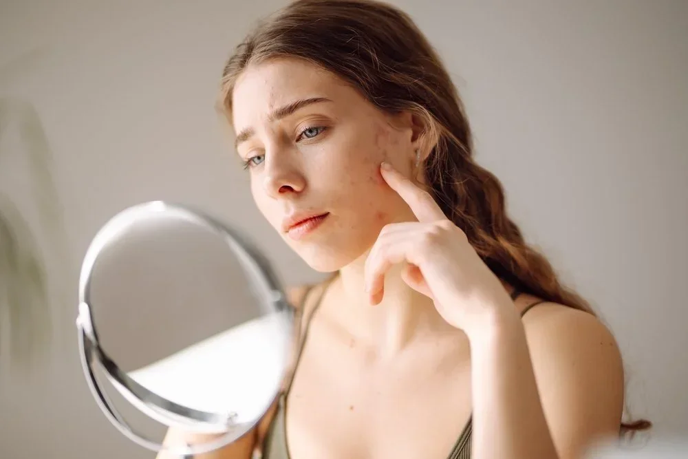 How the Iderm Facial Treatment Can Transform Acne-Prone Skin