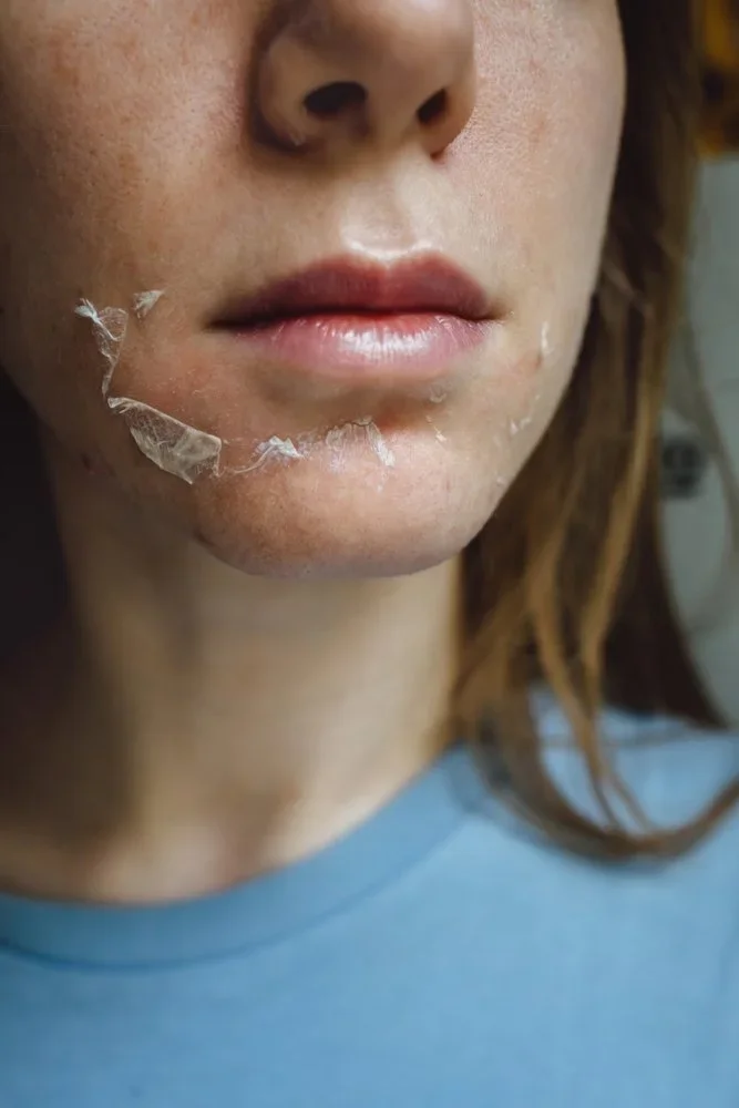 When Is the Best Time for a Chemical Peel? Here's What You Need to Know