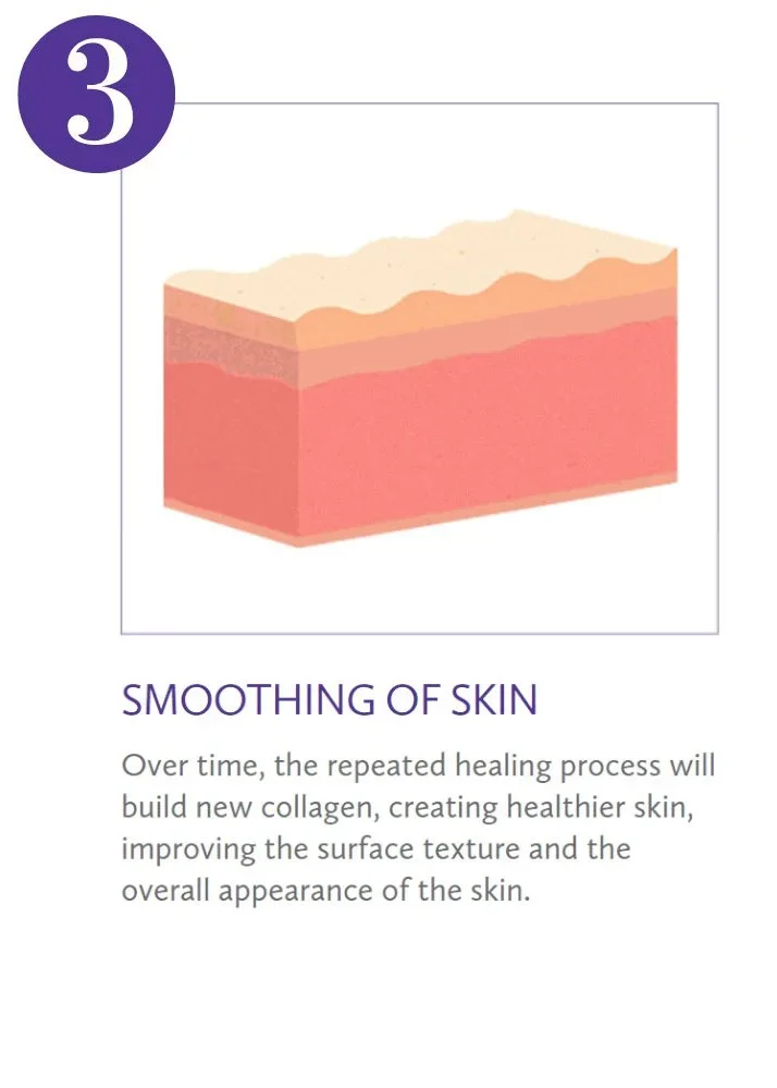 Illustration of skin layers showing the process of skin smoothing or healing.