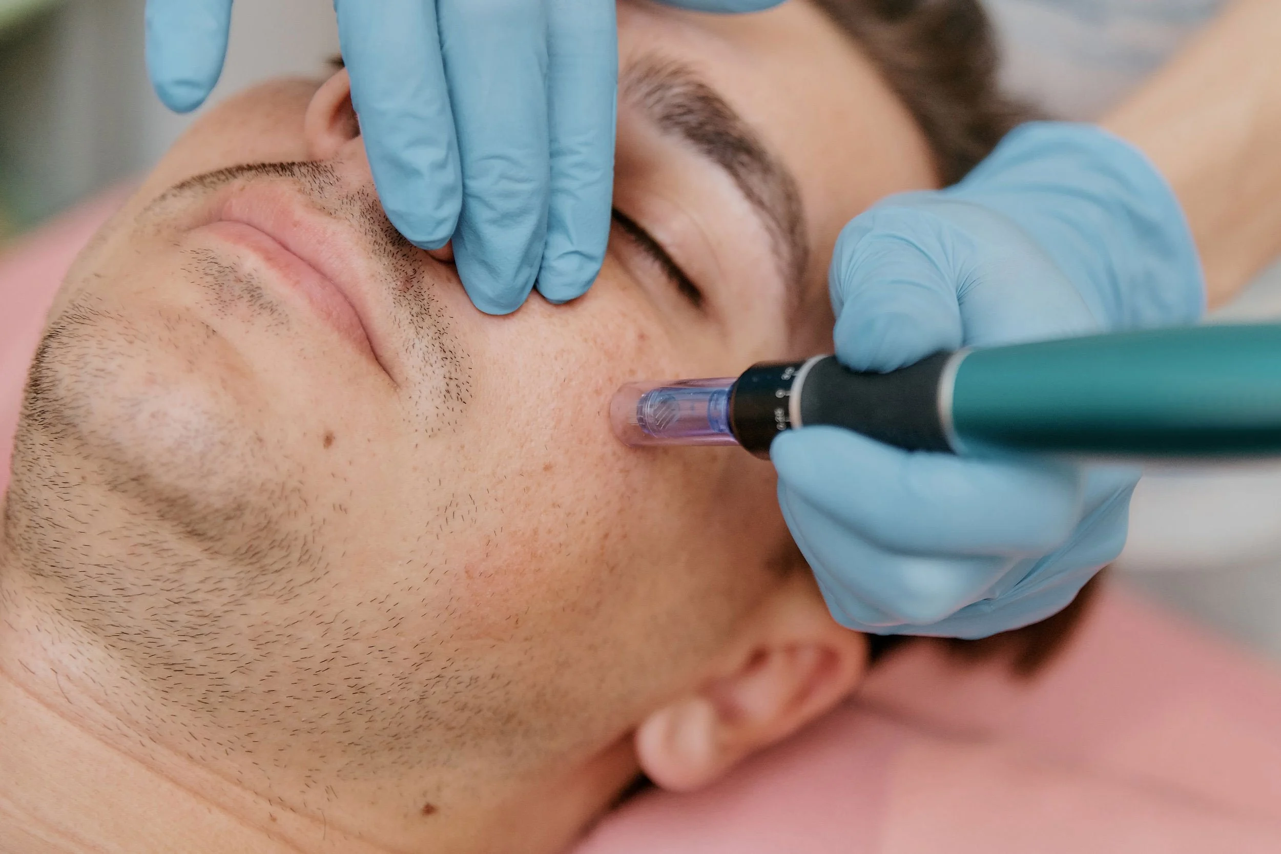 A close-up of a man receiving a cosmetic or medical procedure, with a professional wearing blue gloves using a device on his forehead.