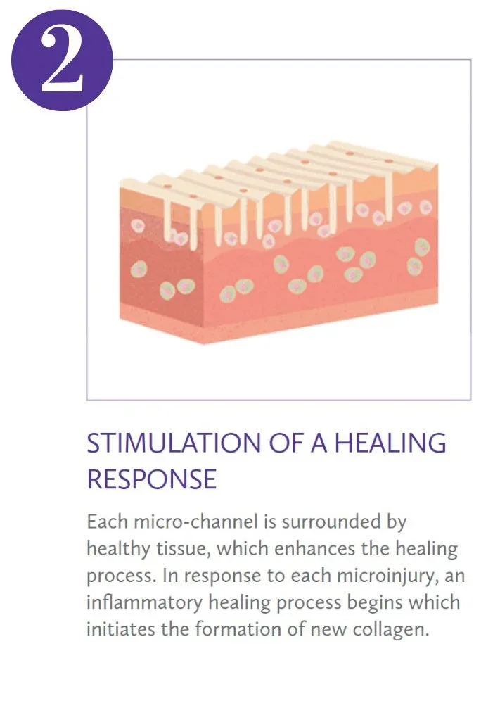 Illustration of skin tissue showing micro-channels surrounded by healthy tissue, representing the stimulation of a healing response.