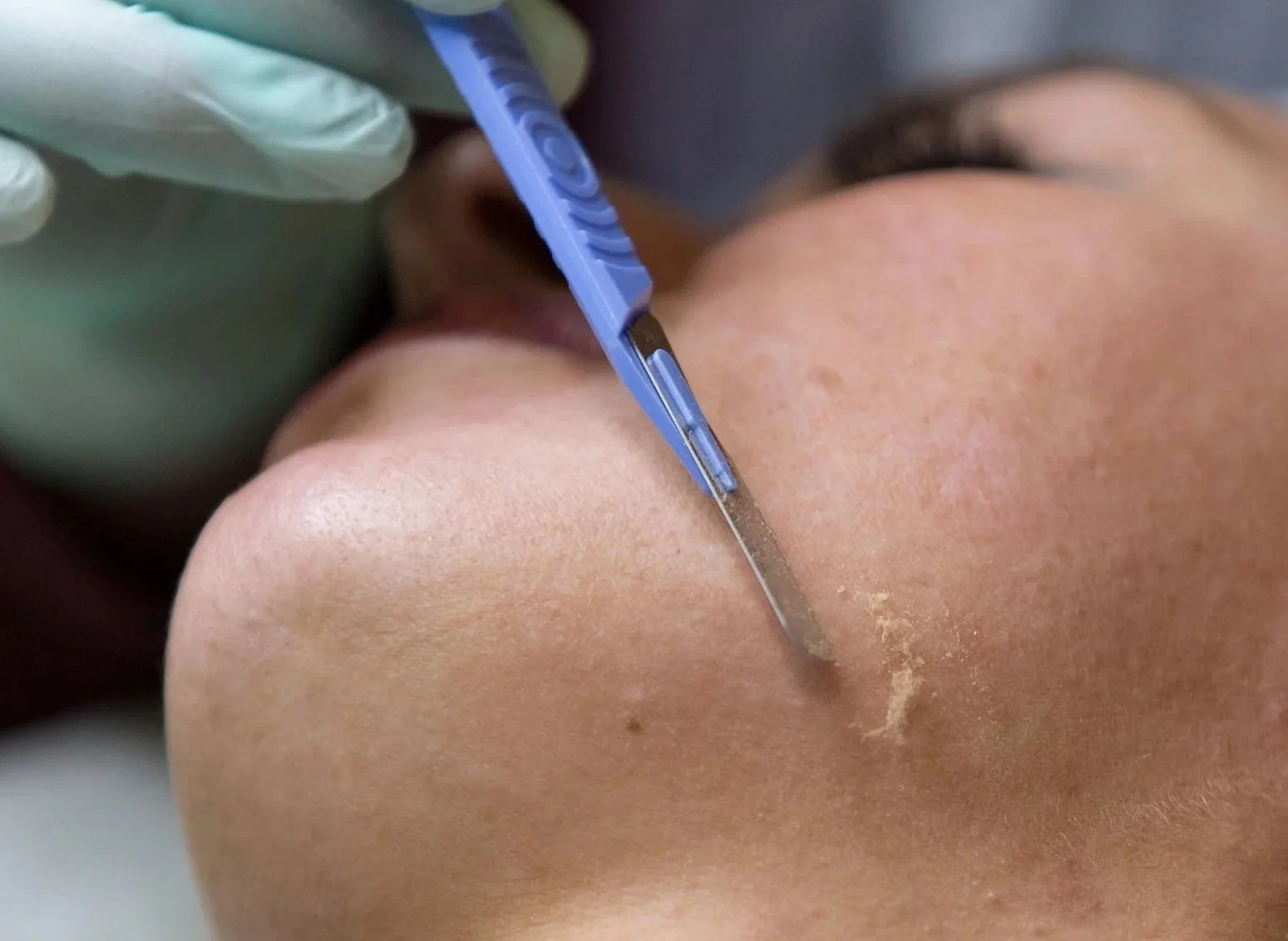A close-up of a person receiving a dermaplaning service from a professional wearing gloves and using a scalpel.