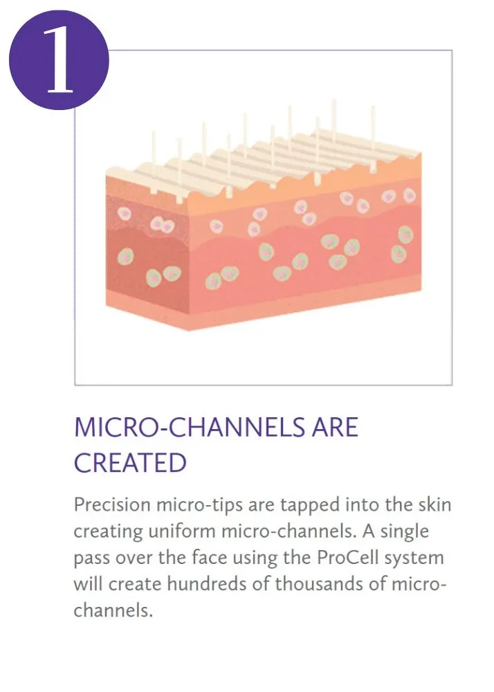 Illustration of a cross-section of skin with micro-needles creating micro-channels.