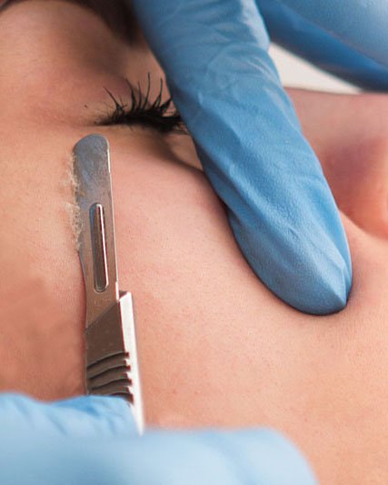 Close-up of a person having a cosmetic procedure on the eyelid with a gloved hand and a surgical instrument.