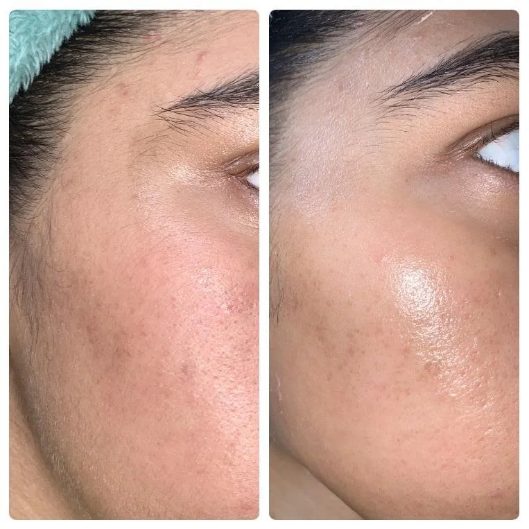 before&afterTSL.jpg