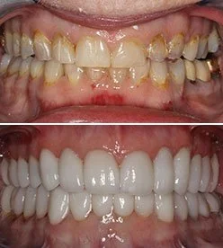 Before and after comparison of teeth, showing improved whiteness and alignment in the lower image. Cosmetic services offered at Legacy Family Dental.