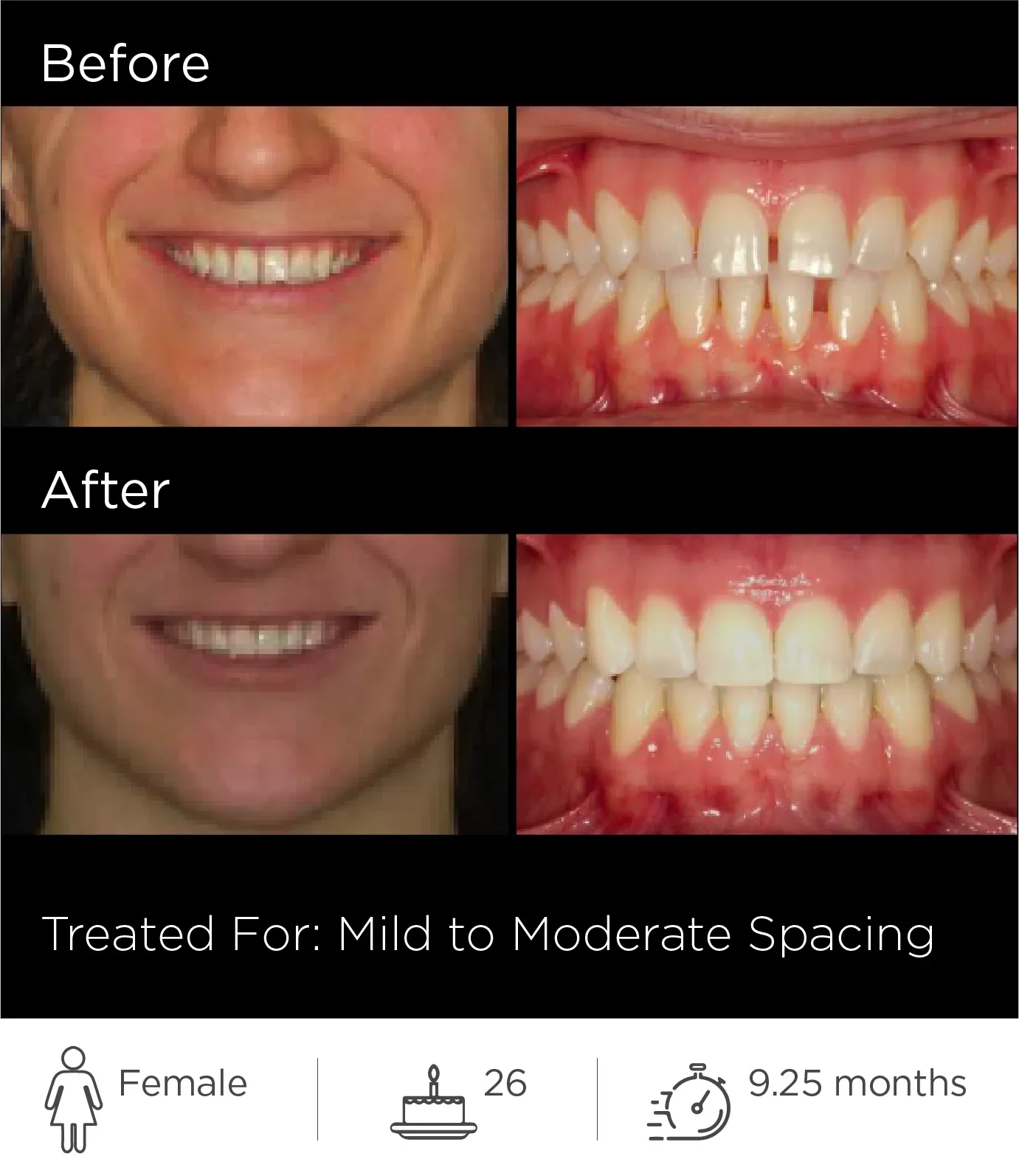 Comparison of a woman's teeth before and after dental treatment for mild to moderate spacing issues, showing improved alignment.