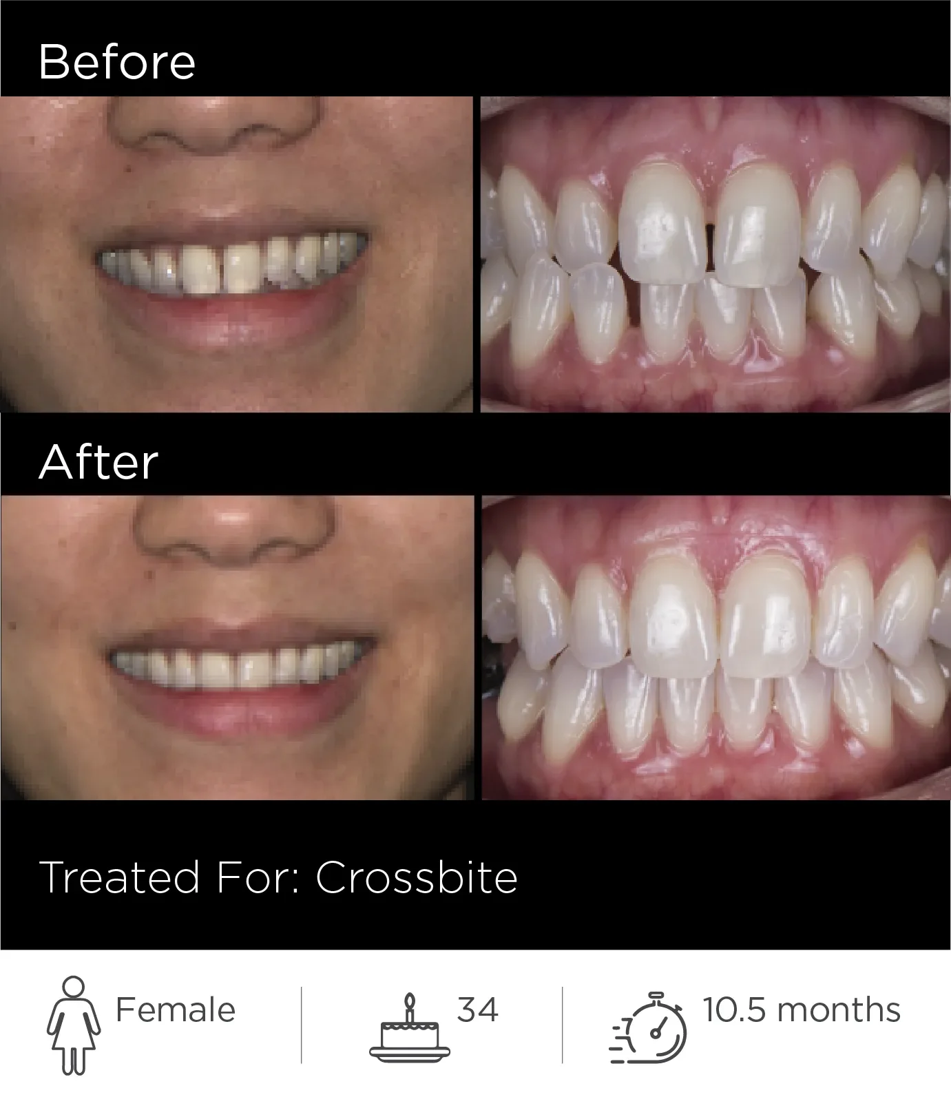 Side-by-side comparison of a person's teeth before and after treatment for crossbite. The 'Before' images show misaligned teeth, while the 'After' images show corrected teeth alignment. Additional information indicates the person is a female, aged 34, with 10.5 months of treatment.