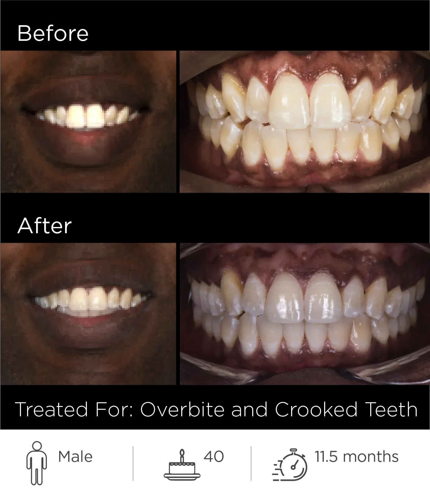 Before and after images of a man's teeth showing improvement after dental treatment for overbite and crooked teeth.