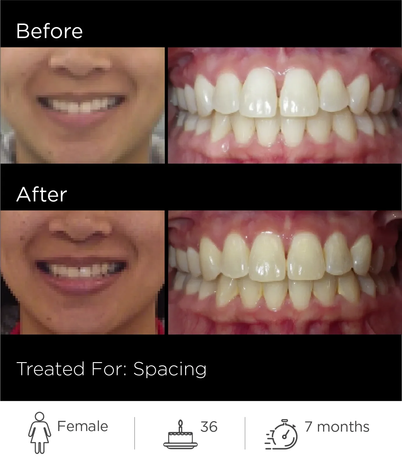 Comparison of a person's teeth and smile before and after orthodontic treatment for spacing. Top row shows the person's smile in the 'Before' and 'After' images, with the skin area around the mouth visible. The second column displays close-up images of the person's teeth, showing alignment improvement. Bottom section includes icons of a female figure, a birthday cake with the number 36, and a clock showing 7 months, along with descriptive text indicating the subject is a 36-year-old female undergoing 7 months of treatment.