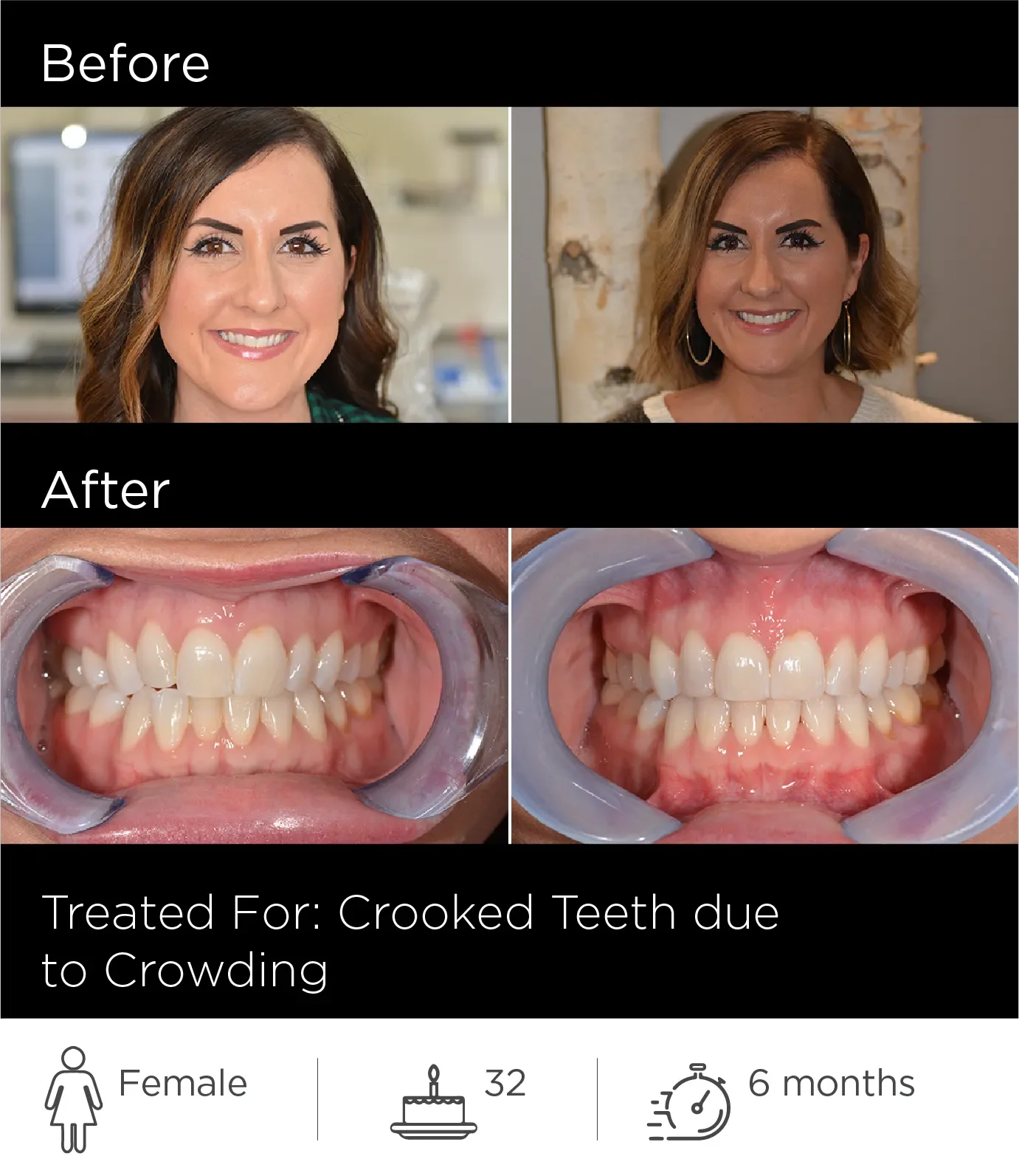 Before and after images showing a woman's teeth, with the after image displaying straightened teeth. The images are labeled for treatment of crooked teeth due to crowding, with icons indicating the patient is a 32-year-old female, with 6 months of treatment.