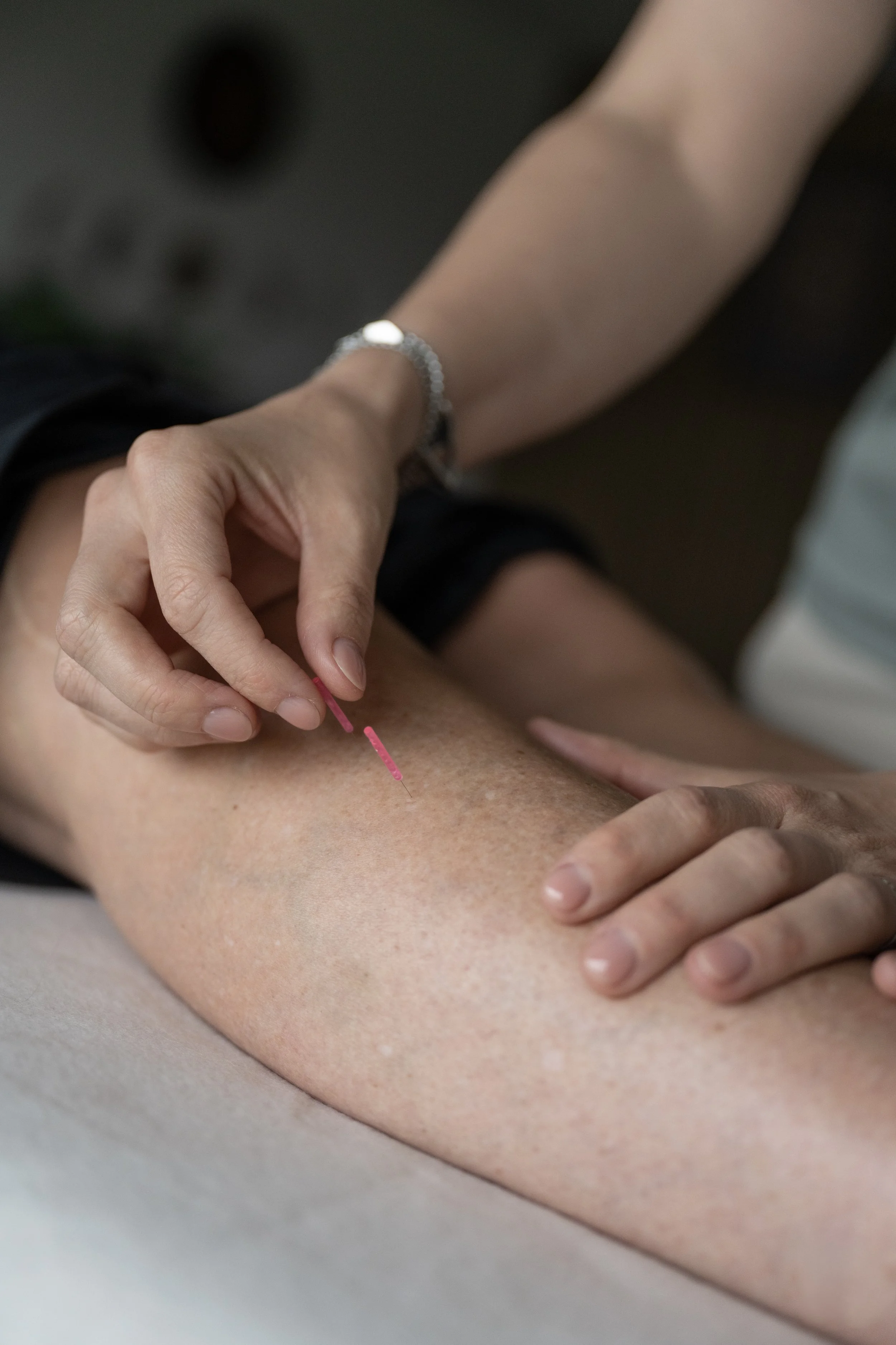 ACUPUNCTURE NEEDLE IN HAND