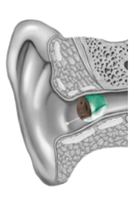 Close-up of a cross-section of a human ear showing the ear canal, eardrum, and inner ear structures with a small biodegradable tube placed in the ear canal.