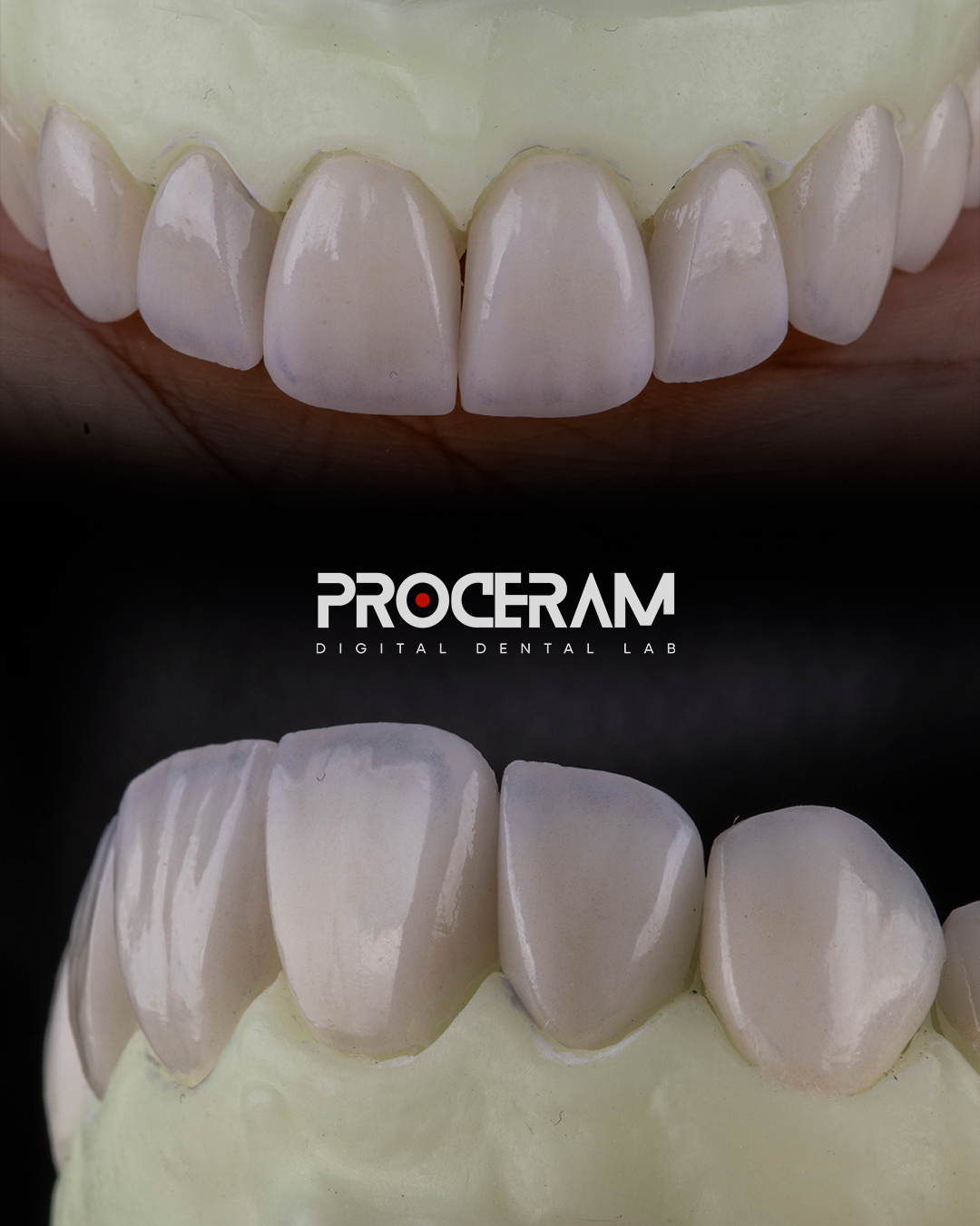 Veneers in hand.png