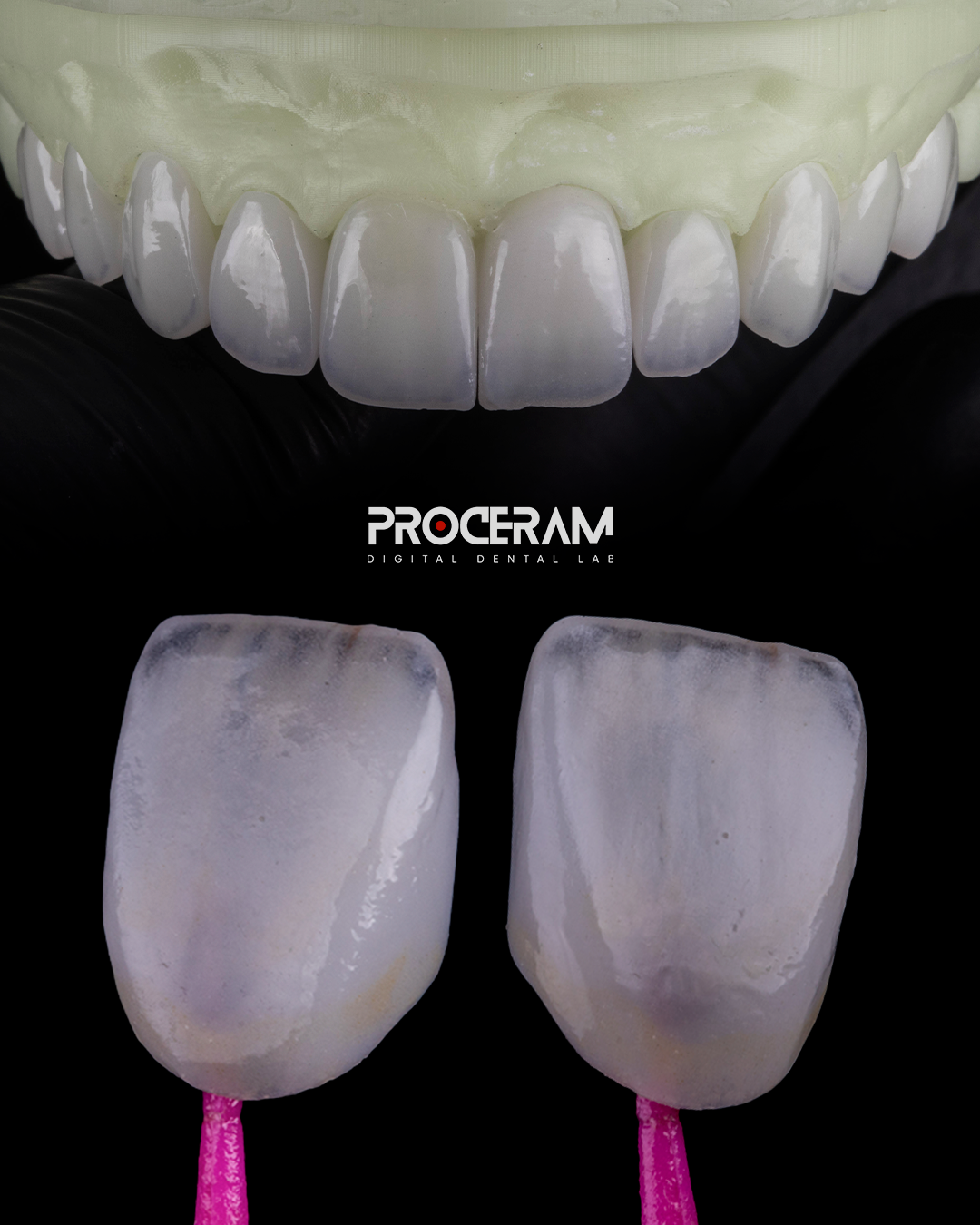 Veneers.png