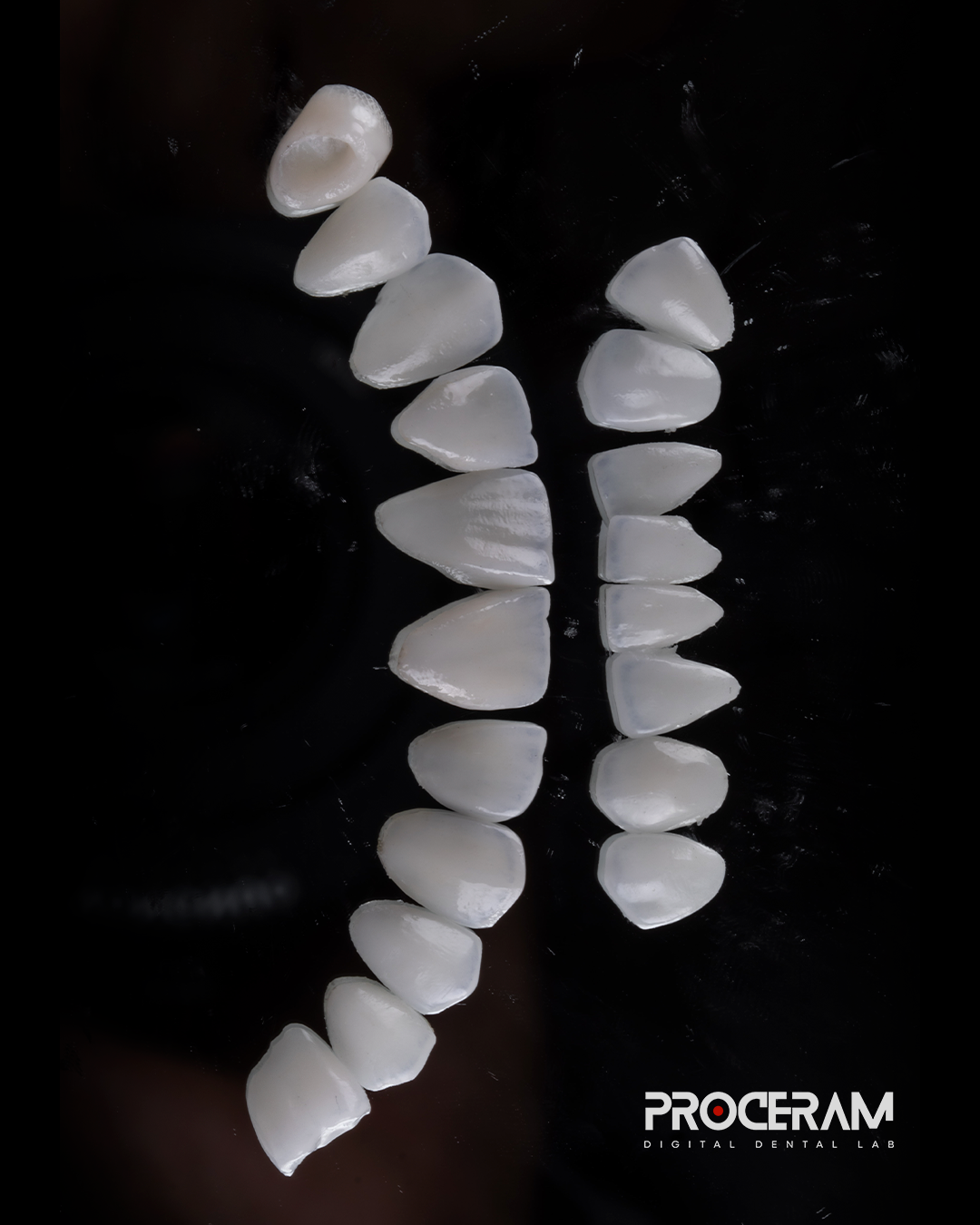 Veneers 3.png