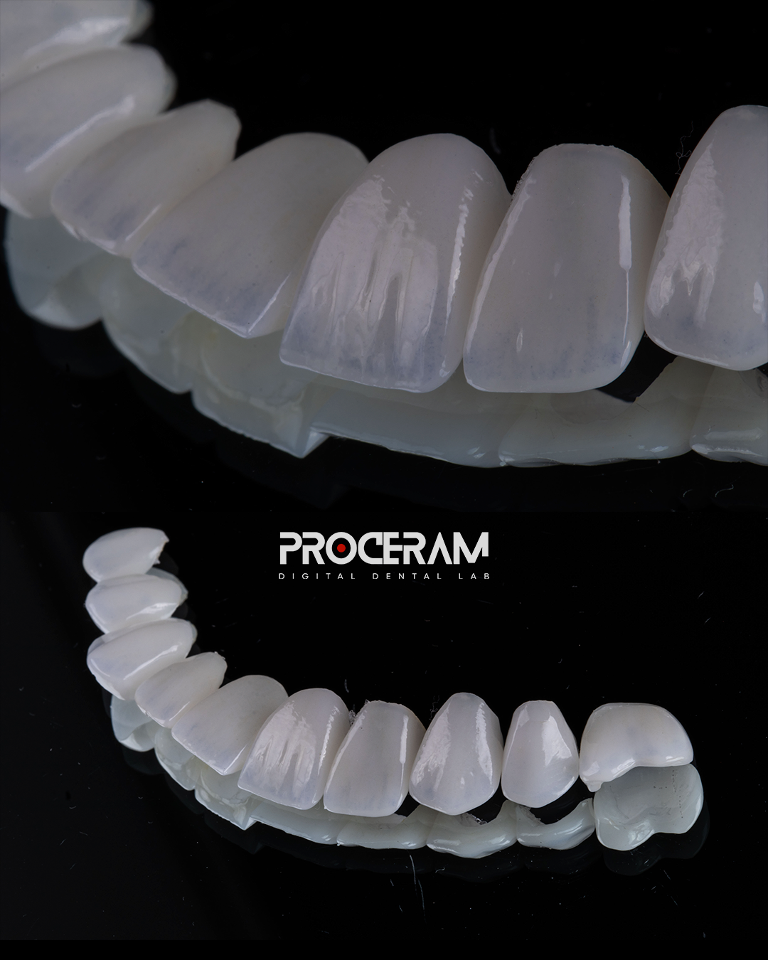 Giselli Veneers.png