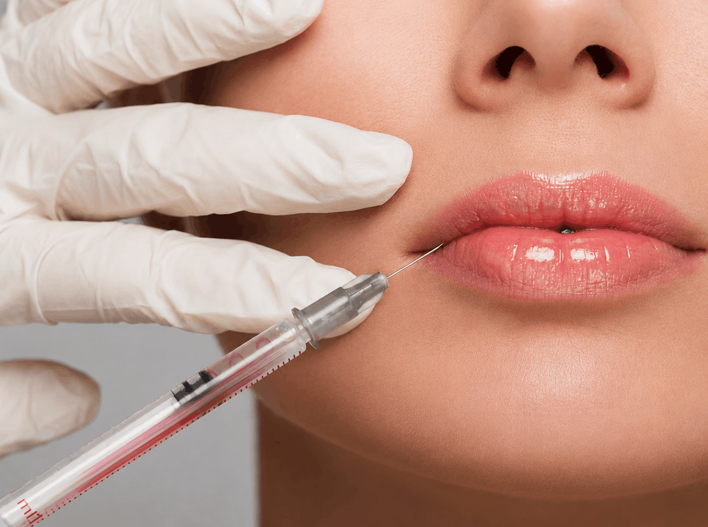 A person receiving lip injections from a medical professional wearing blue gloves, using a syringe.