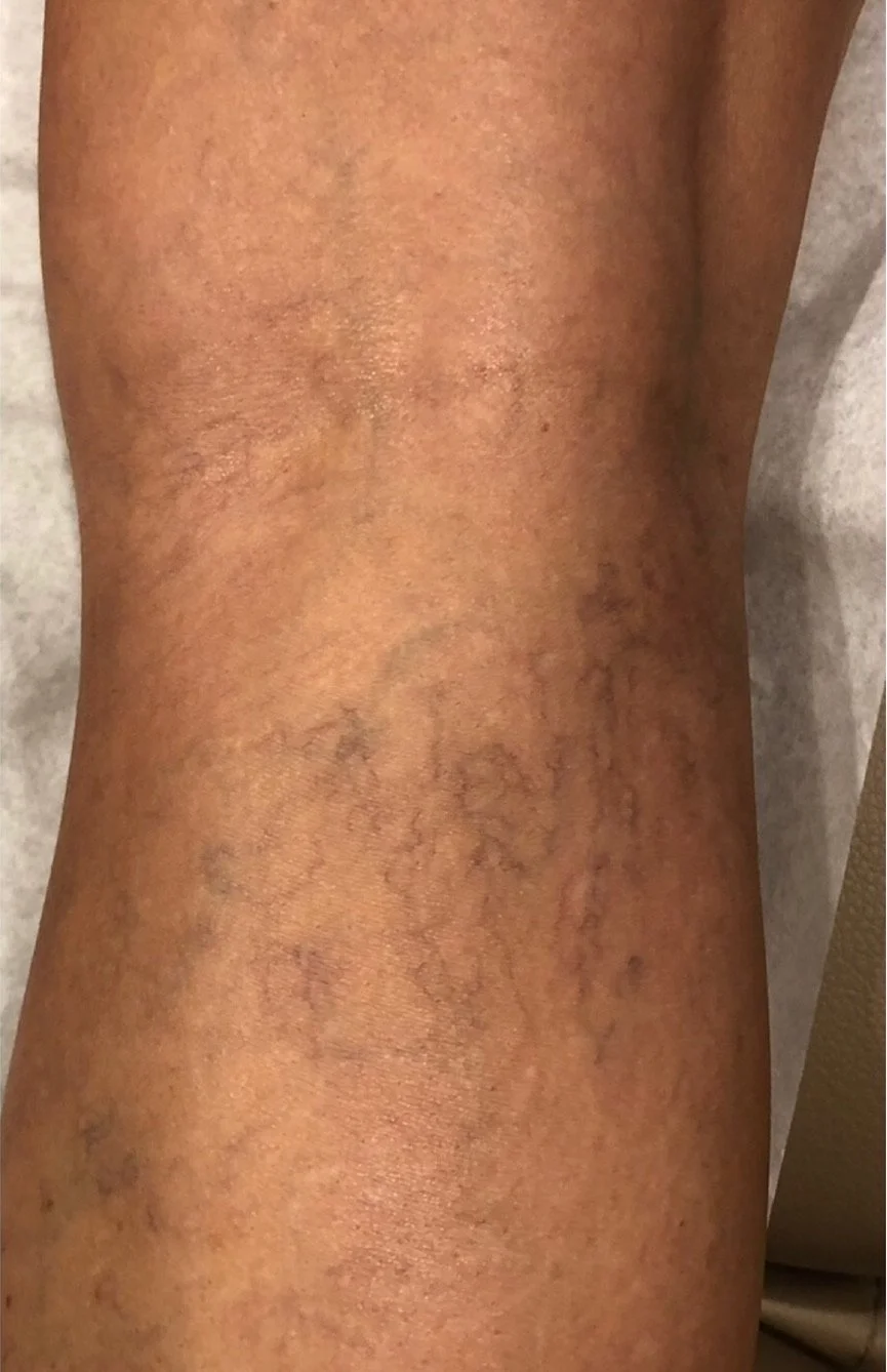 Close-up of a person's arm with visible spider veins and mild skin discoloration.