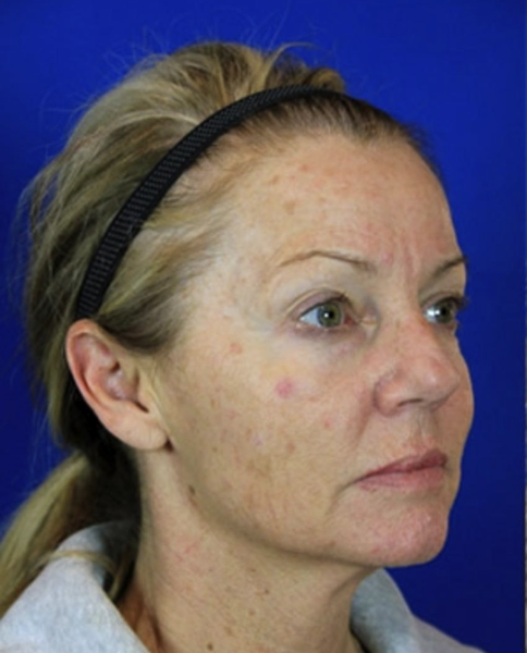 A woman with light skin and blonde hair pulled back with a black headband, facing to the right. She has redness and acne scars on her face, set against a plain blue background.