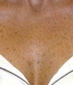 Close-up of a person's chest and neck area, showing skin with freckles and a white garment with a zipper.