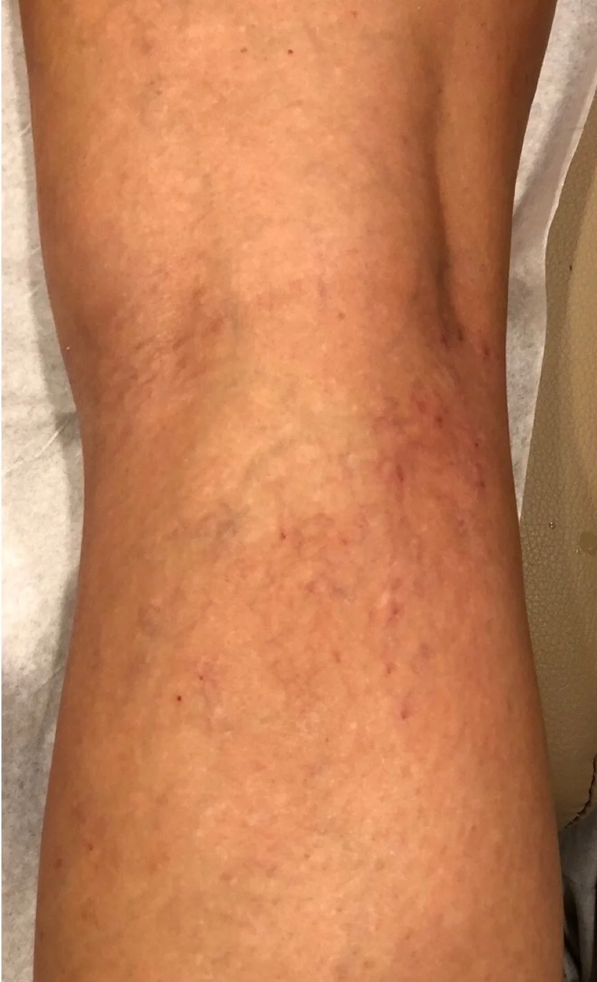 Close-up of a person's leg with scar tissue, redness, and small spots on the skin.