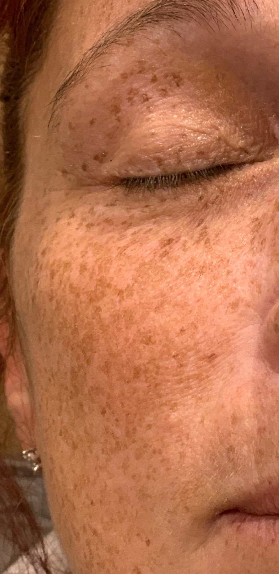 Close-up of a person's face with prominent freckles, closed eye, and visible skin texture.