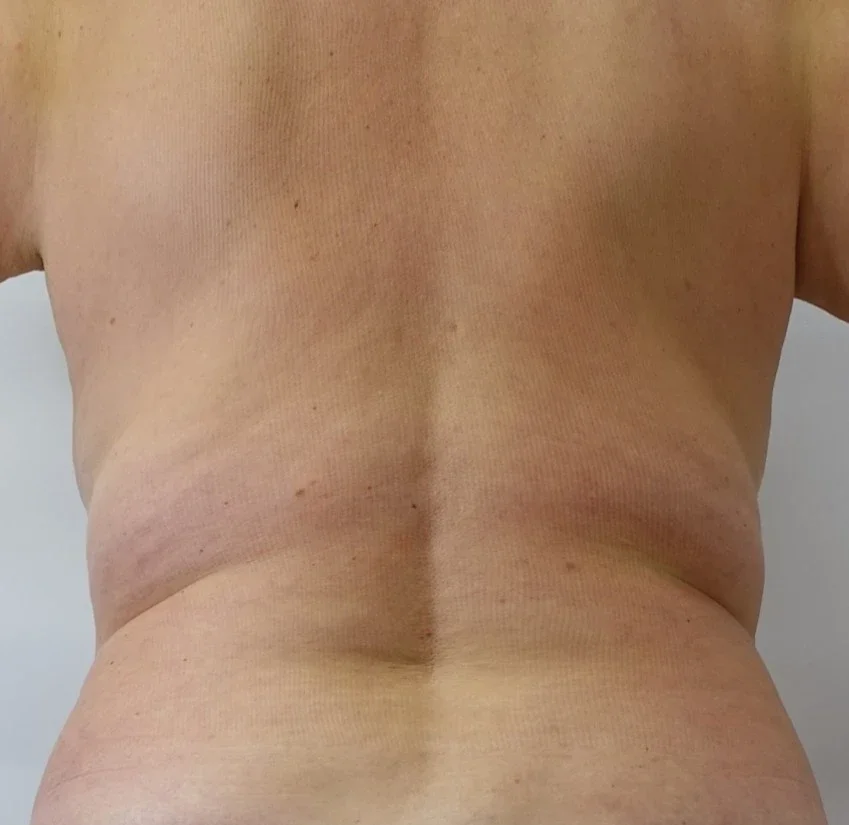 9After 12 sessions.webp