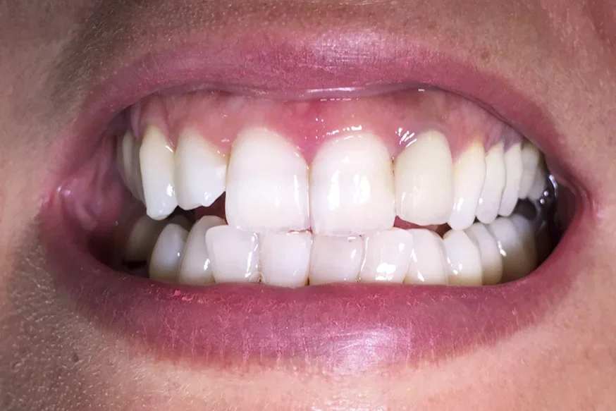 Après greffe gingivale