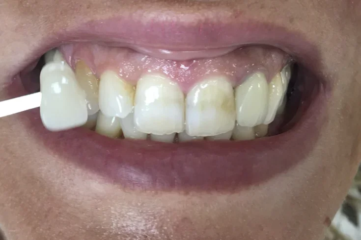 Avant greffe gingivale, récession visible