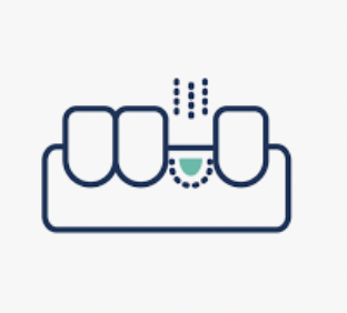Sinus Lift and Bone Grafting, AWOMS, Albury, Griffith, Wagga Wagga, Wangaratta