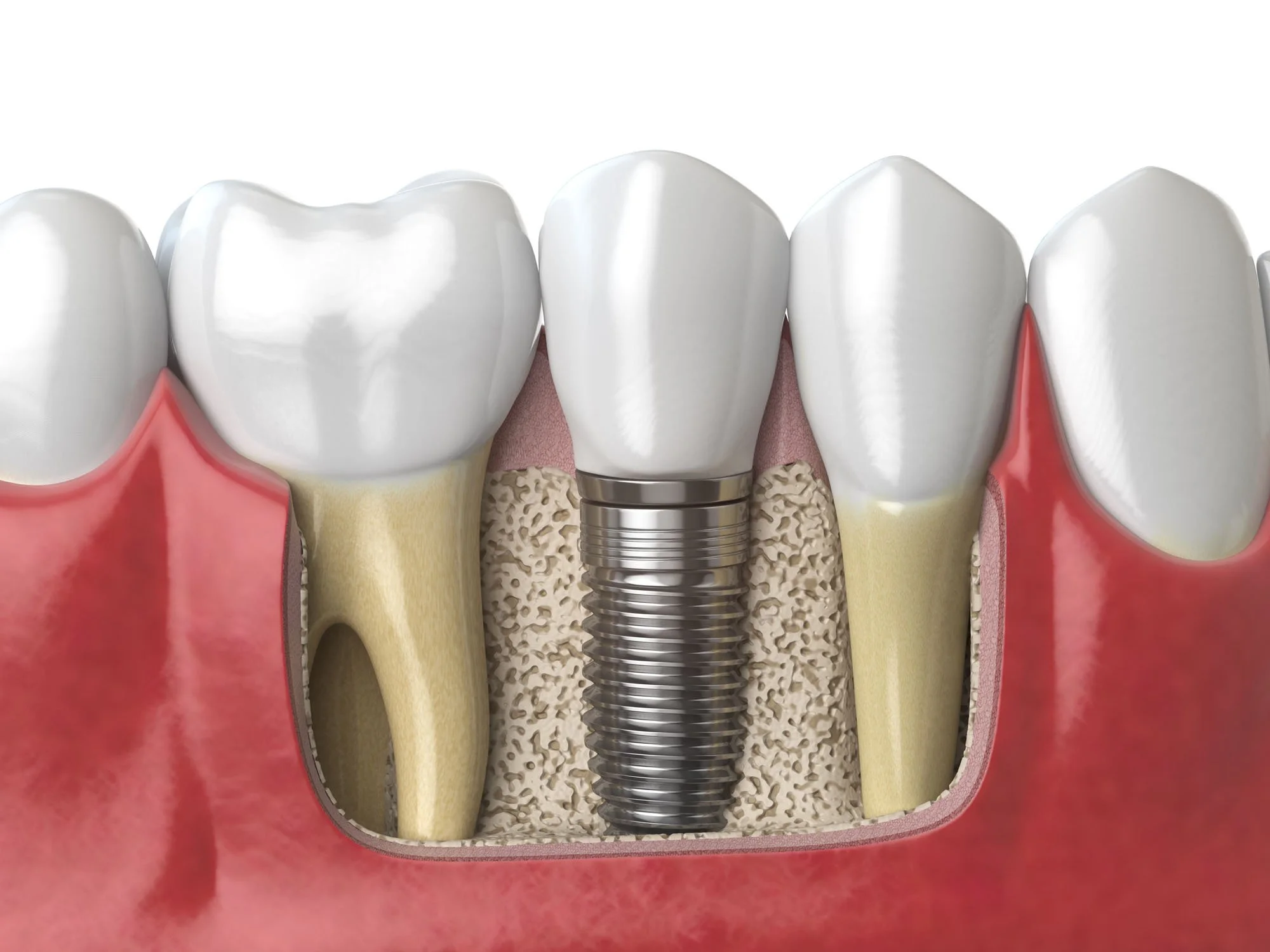 The Relationship Between Gum Health and Implants